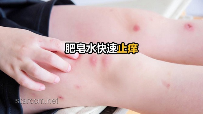 **被蚊子咬了能迅速止痒的4个方法，希望大家都用不上！**
